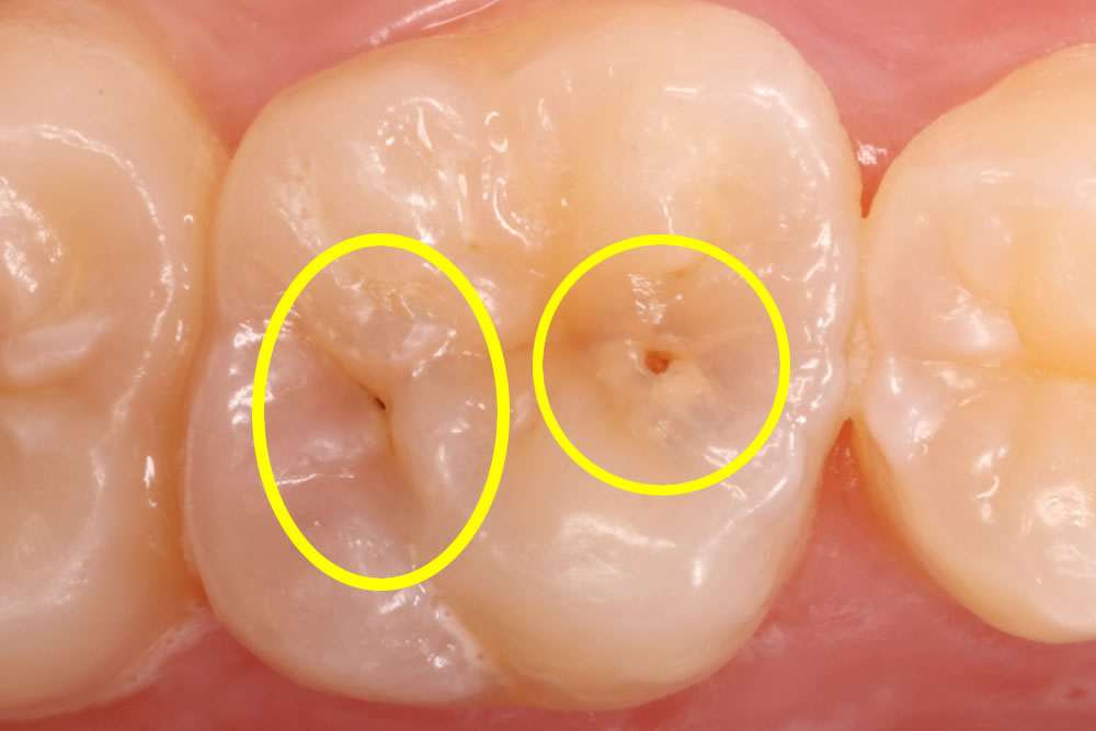 痛く ない 虫歯 治療 すべ きか