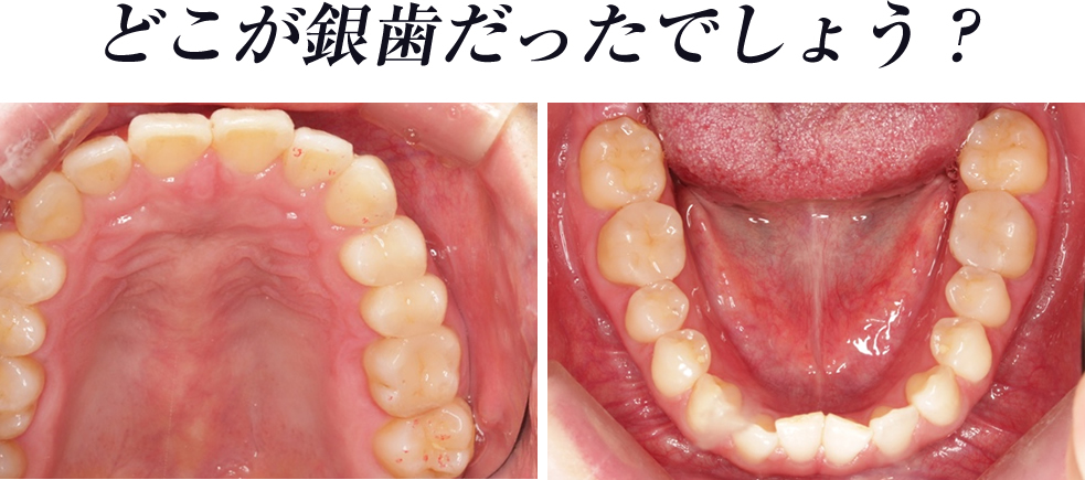 どこが銀歯だったでしょう？