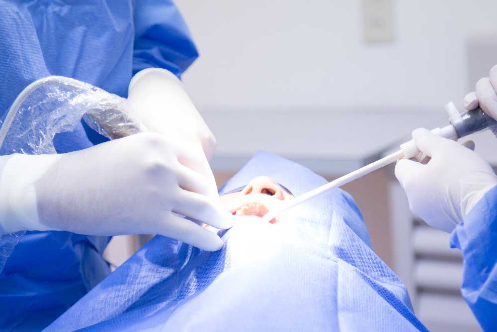 歯根端の切除