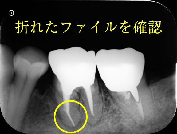 根管治療の再発原因 width=