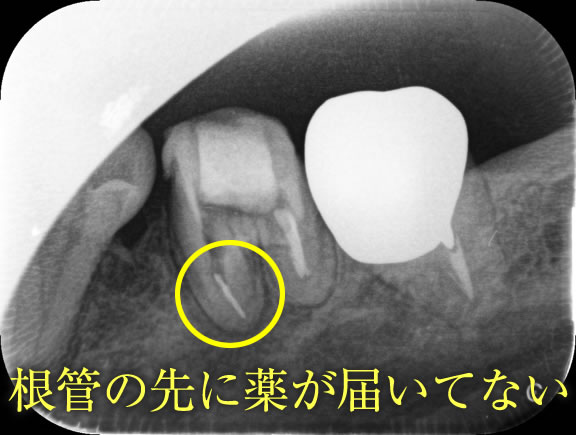 根管治療の再発原因