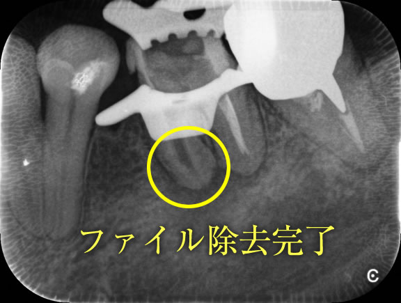 根管治療の再発原因