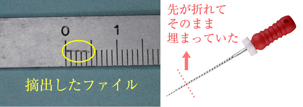 根管治療の再発原因