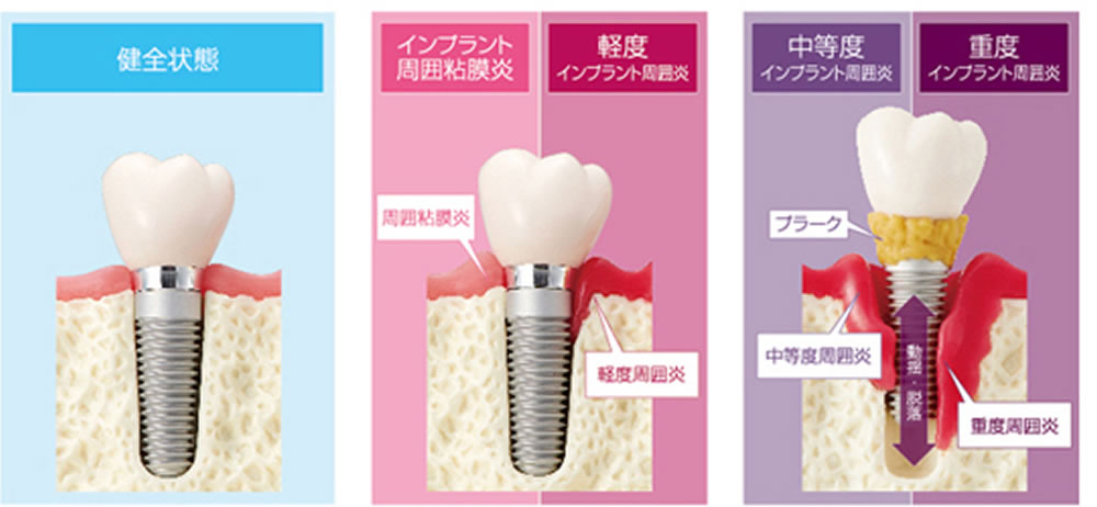 インプラント治療アフターケア