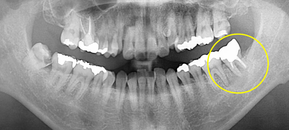 奥歯の抜歯