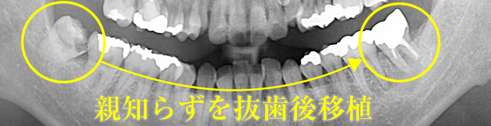 自家歯牙移植