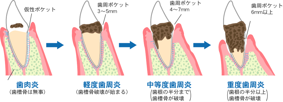 歯周病の治療の仕方