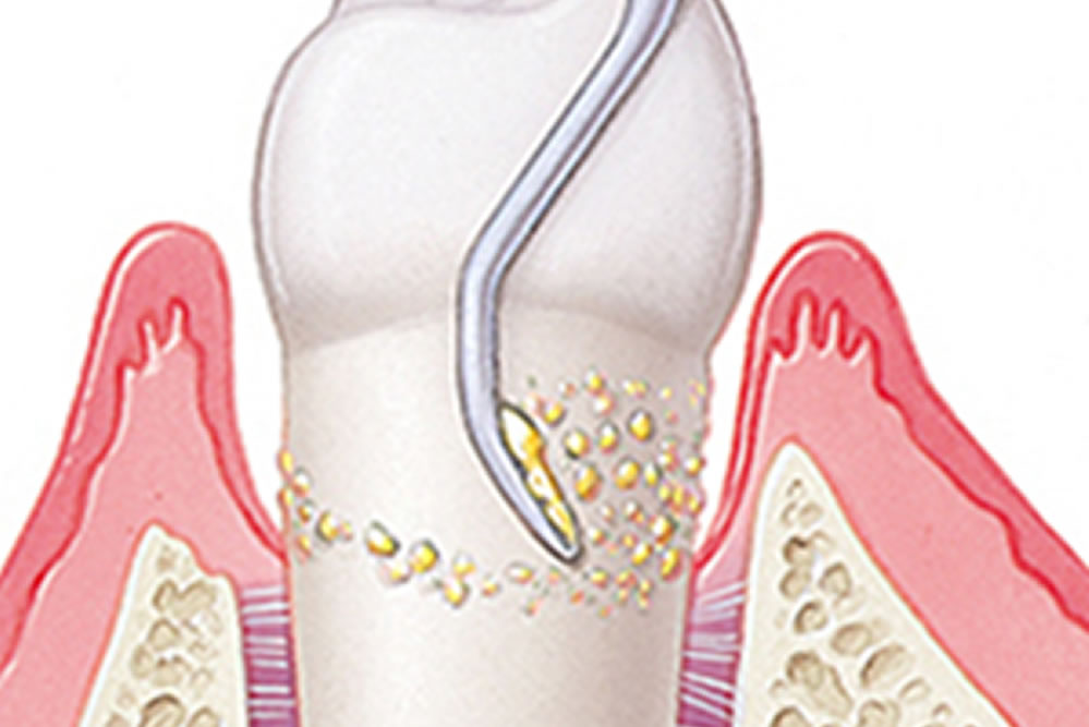 中度の歯周病