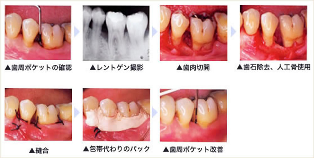 重い歯周病